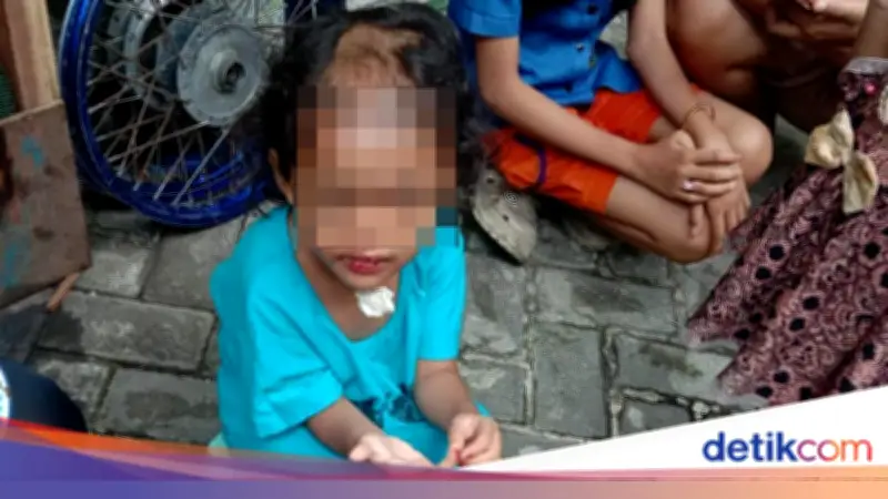 Balita 4 Tahun di Surabaya Dianiaya Paman dan Bibi Selama 2 Bulan