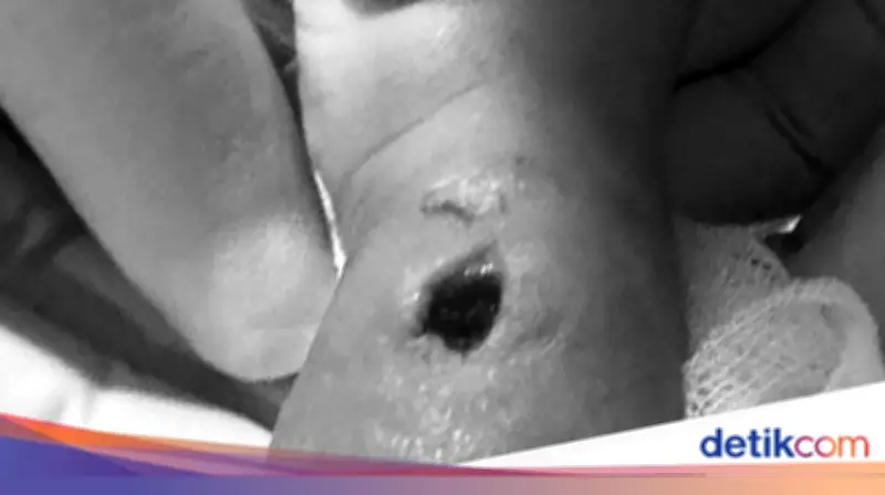Tangan Bayi Bengkak-Berlubang Usai Diinfus, Orang Tua Laporkan RS Paramount Makassar ke Polisi