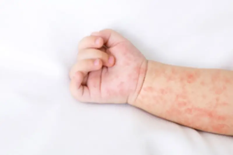 Dinkes Jabar Tindak Lanjuti Instruksi Gubernur Soal Kasus Meninggal Dokter Muda Diduga Campak