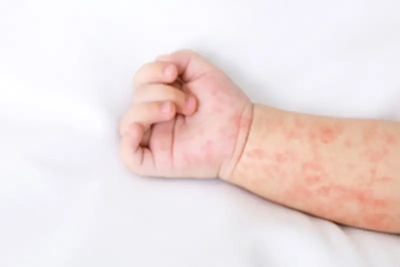 Pakar IPB Ingatkan Bahaya Campak yang Bisa Berujung Kematian, Jangan Tunda Vaksin