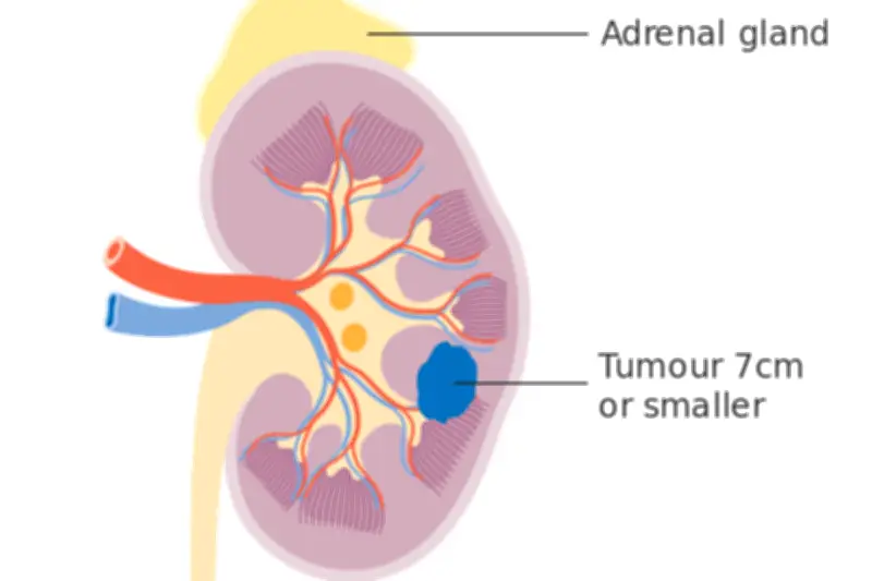 Kanker Ginjal Sering Terdeteksi Stadium Lanjut, Dokter UGM Ungkap Penyebabnya
