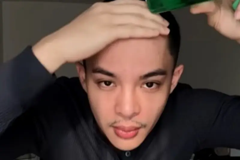 Rey Mbayang Cukur Botak karena Autoimun Psoriasis, Bukan Gaya