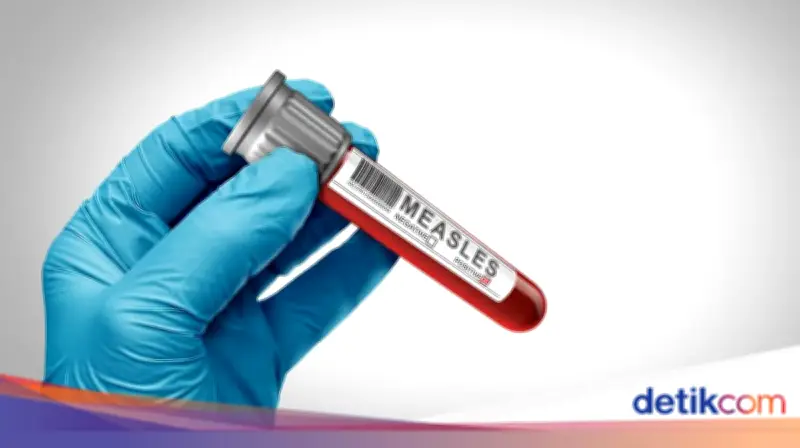 Wabah Campak Banten: 4.456 Suspek, 157 Positif, dan 6 Korban Meninggal