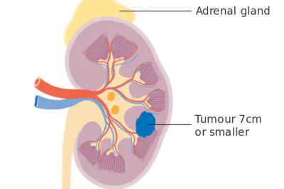 Kanker Ginjal Sering Terdeteksi Stadium Lanjut, Dokter UGM Ungkap Penyebabnya