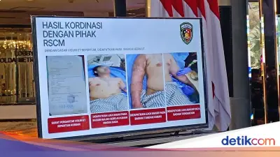 RSCM Sebut Kondisi Luka Bakar Andrie Yunus Membaik Signifikan Setelah Operasi